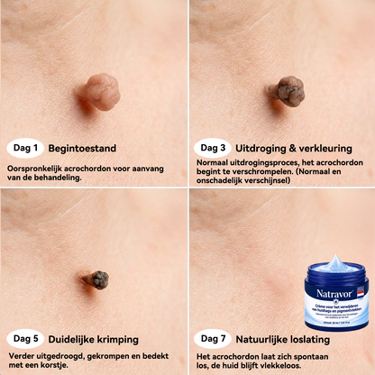 Natravor® Geavanceerde Corrigerende Crème voor Huidflapjes, Moedervlekken & Vlekken – 7 Dagen Zonder Pijn & Zonder Littekens – Geavanceerde Verzorging voor Huidoneffenheden